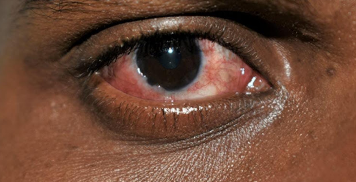 the-surge-of-red-eye-disease-in-kenya-s-coast-region-mwakilishi